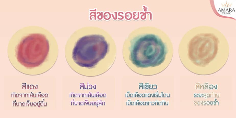 รอยช้ำ