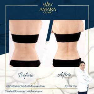 Review Sexy Line Liposuction 2