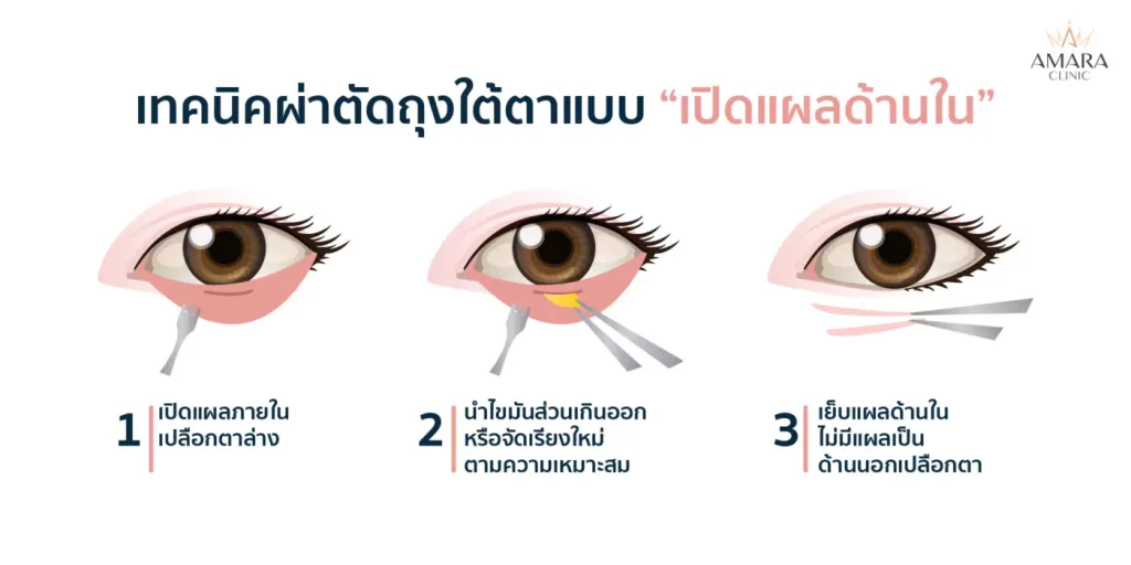 ผ่าตัดถุงใต้ตา