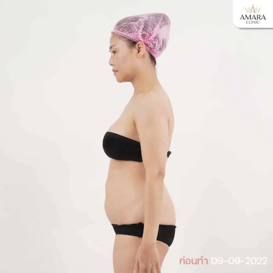 Liposuction at Amara Clinic review