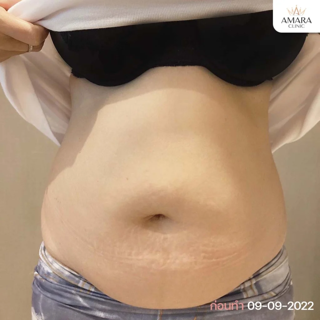 Before Liposuction review
