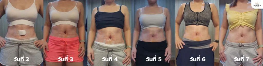 9404 after tummy tuck 08