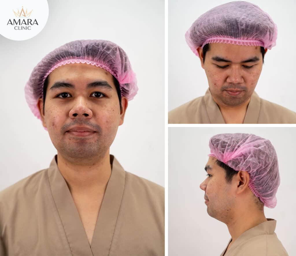 Before Double chin liposuction - Mr. Check