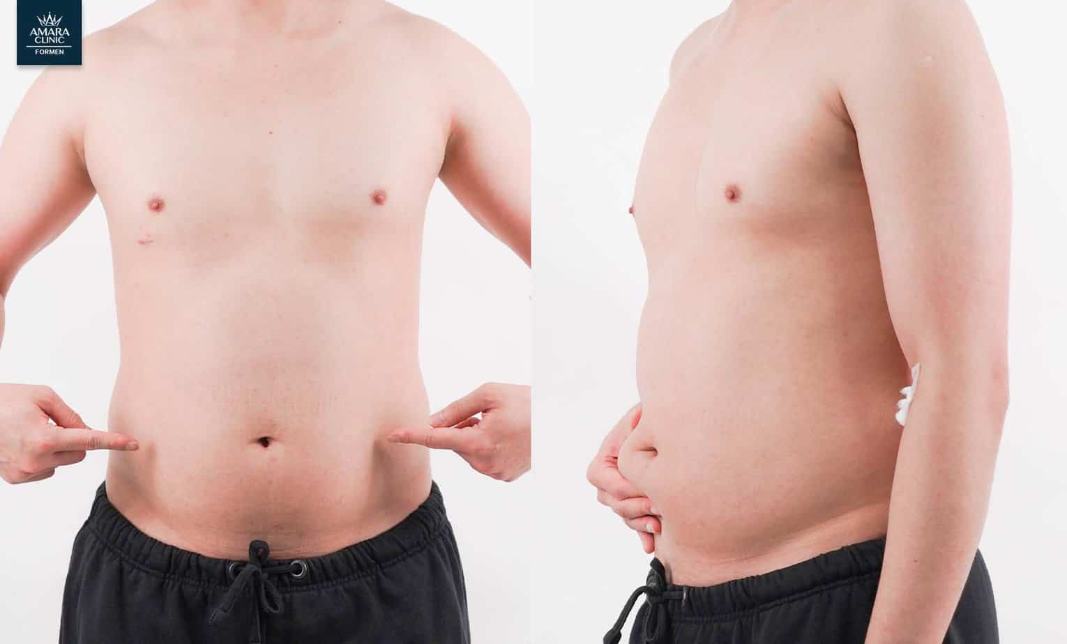 Review - Before liposuction