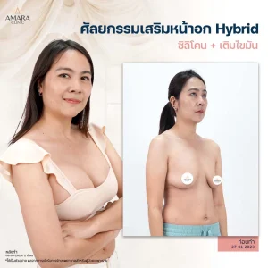 Breast Augmentation Hybrid technique reviews No.9050