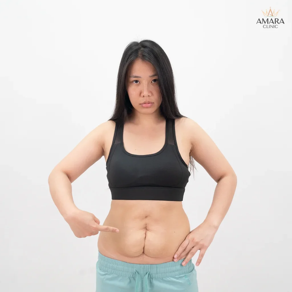 review tummy tuck 11004 02