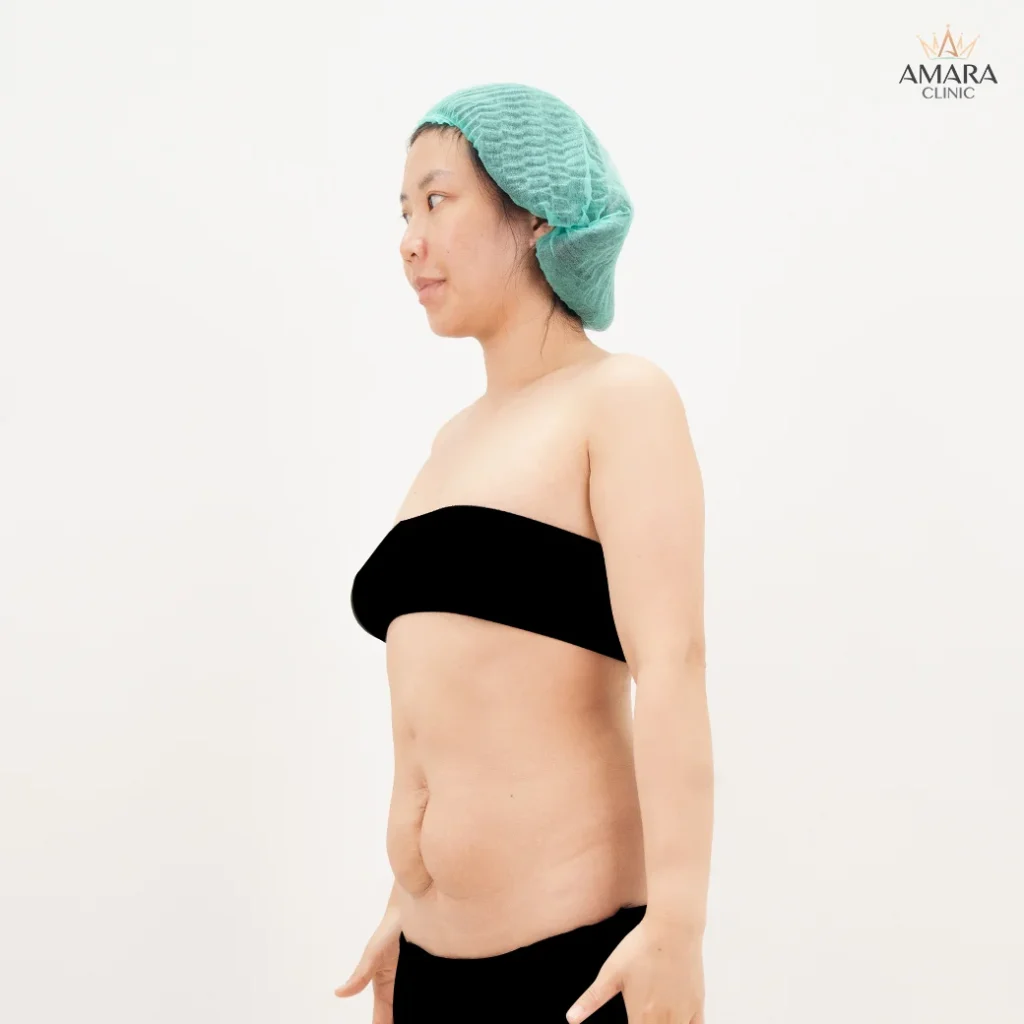 Result after tummy tuck review No. 11004/