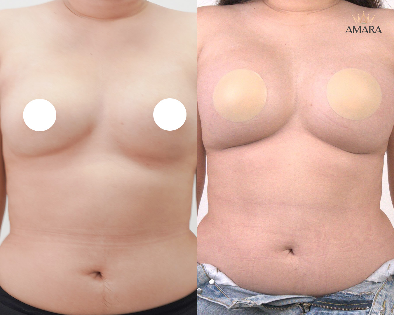 Khun Fahfon Breast Augmentation Clinical Comparing