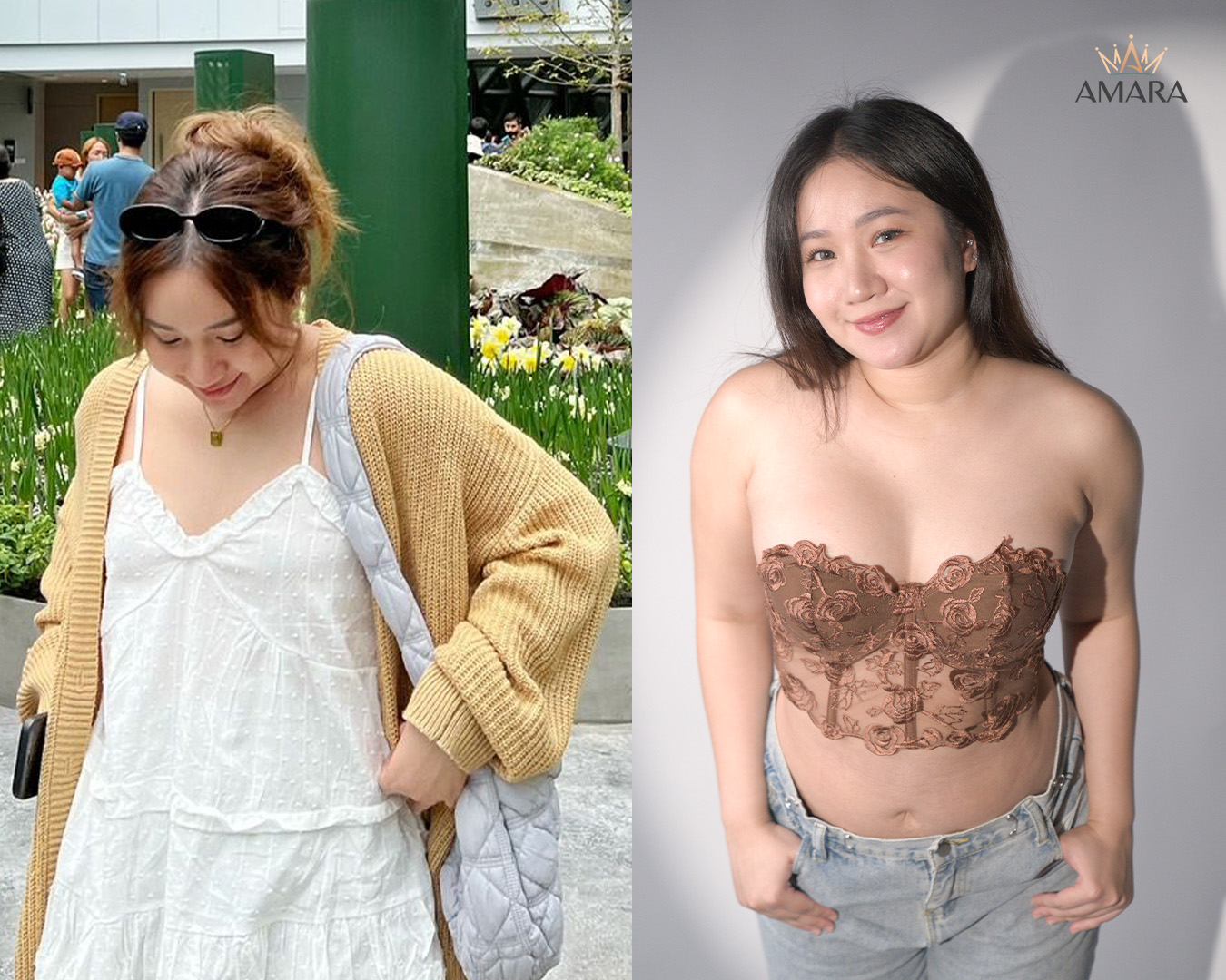 9948 Breast Augmentation Before and After