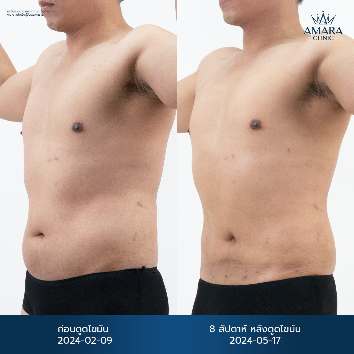 Before and After Liposuction 