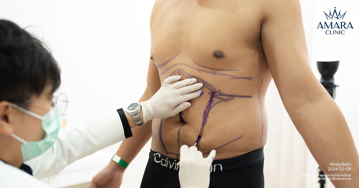 Liposuction Clinical Consultation