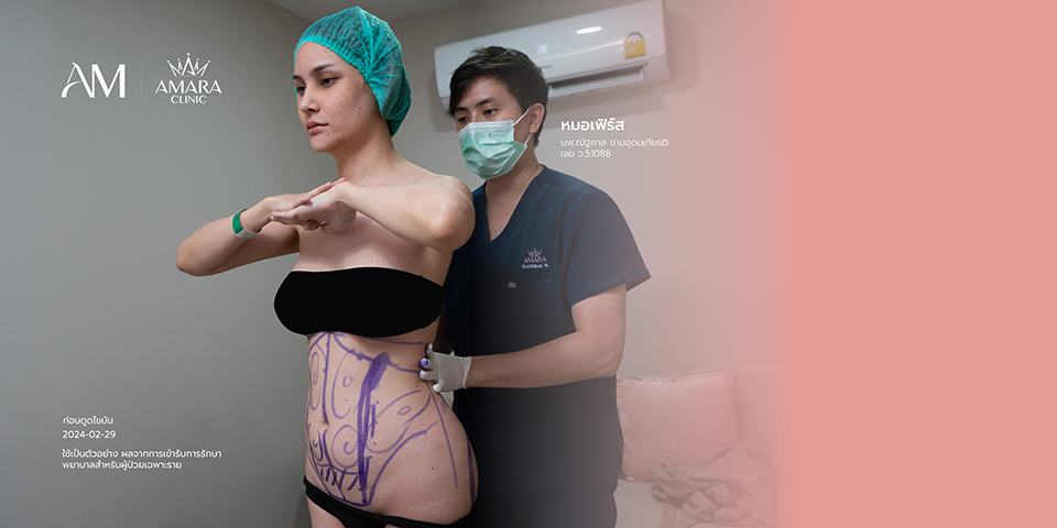 Liposuction Clinical Consultation